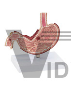 The dissection model of diseased stomach